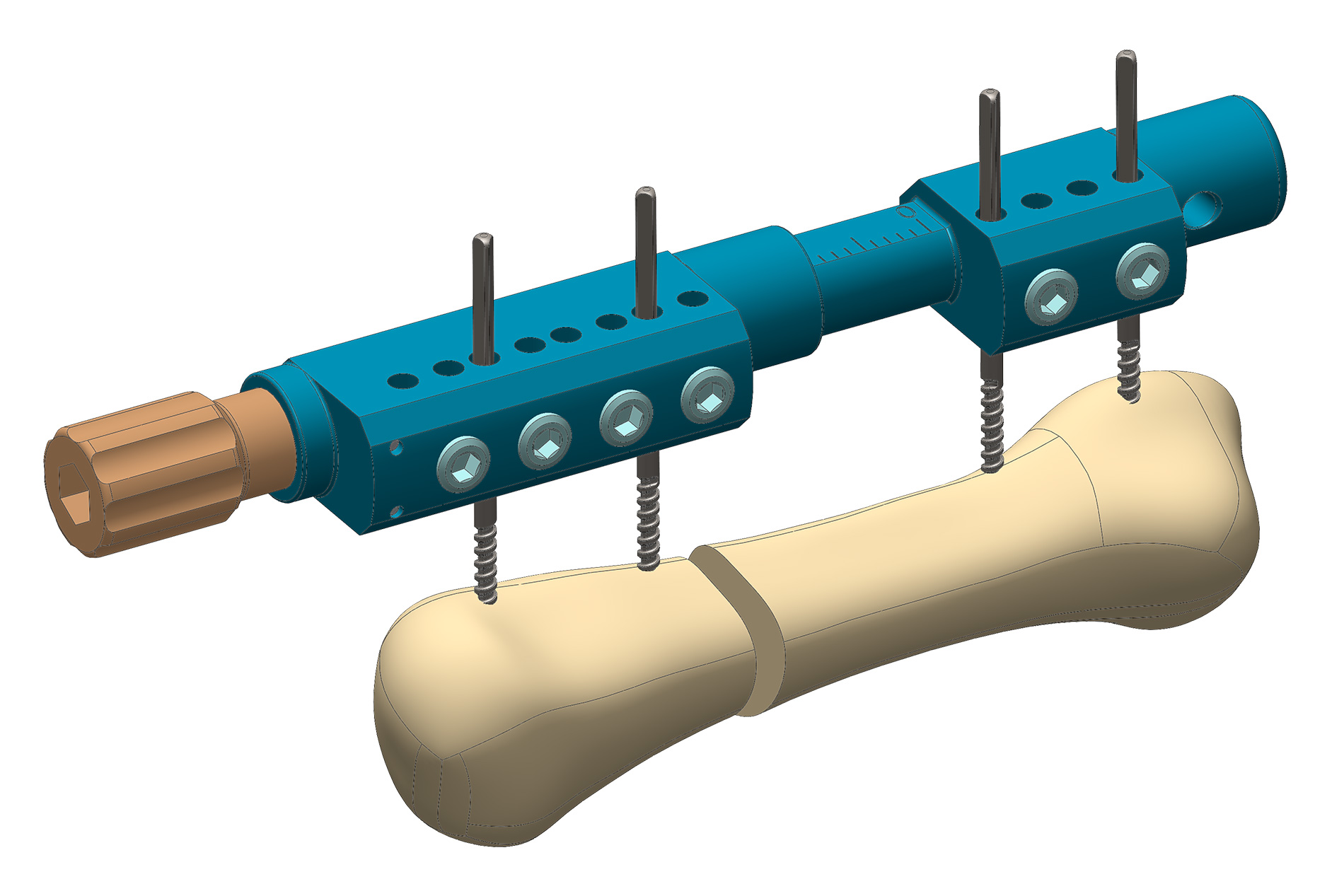 MiniBone : Fixateur et allongement des mains et des pieds